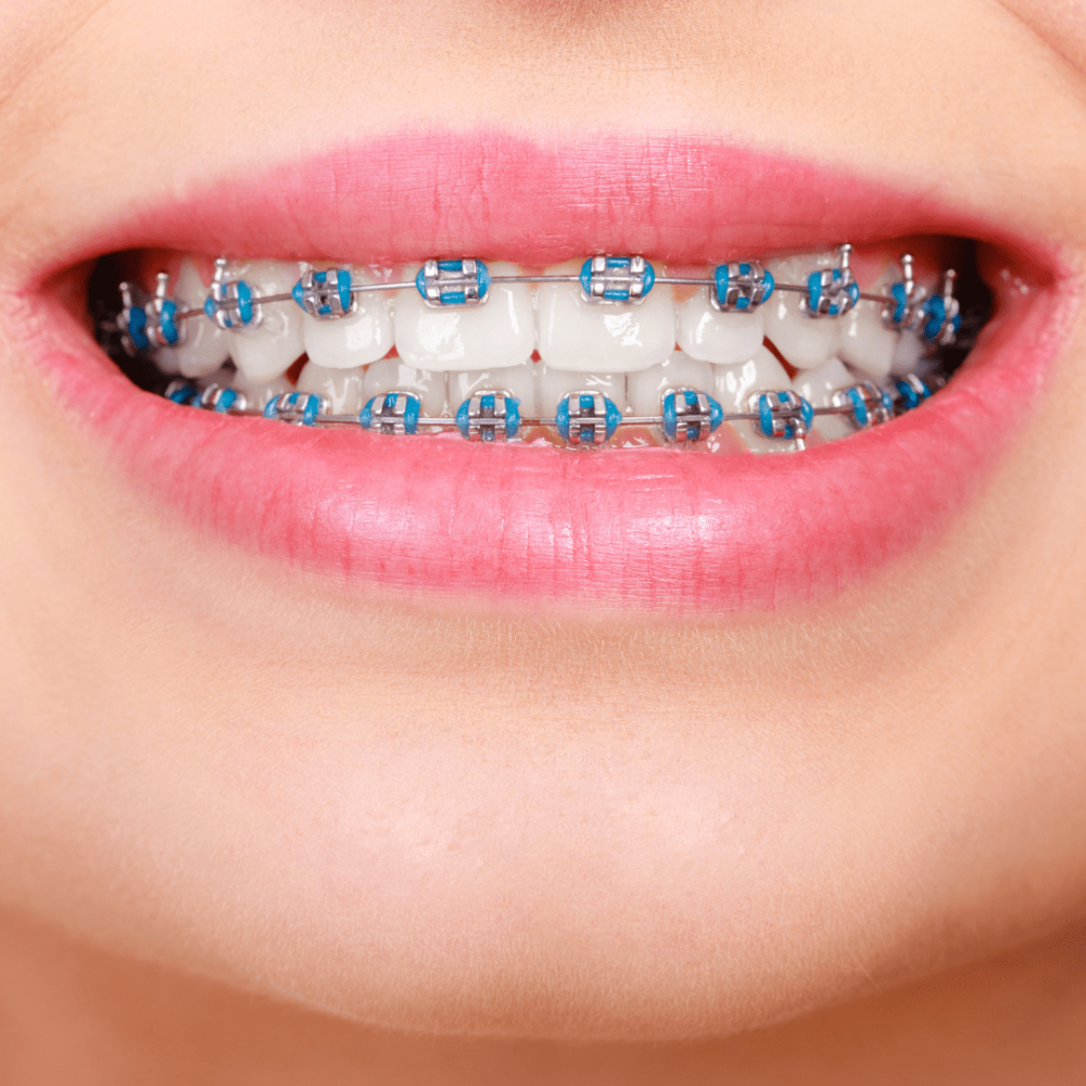 Braces-min.png