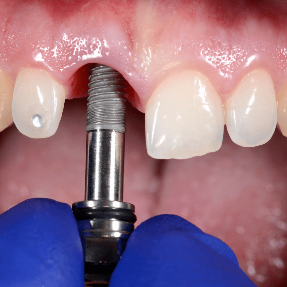 Dental-Implant-min.png