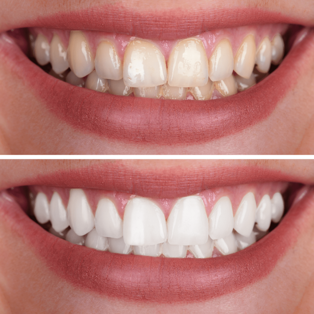 Teeth-Whitening-min.png