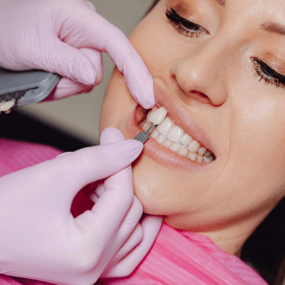 Veneers-min.png